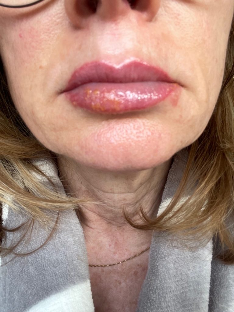 Lippen-Herpes am Tag 3 nach der Behandlung